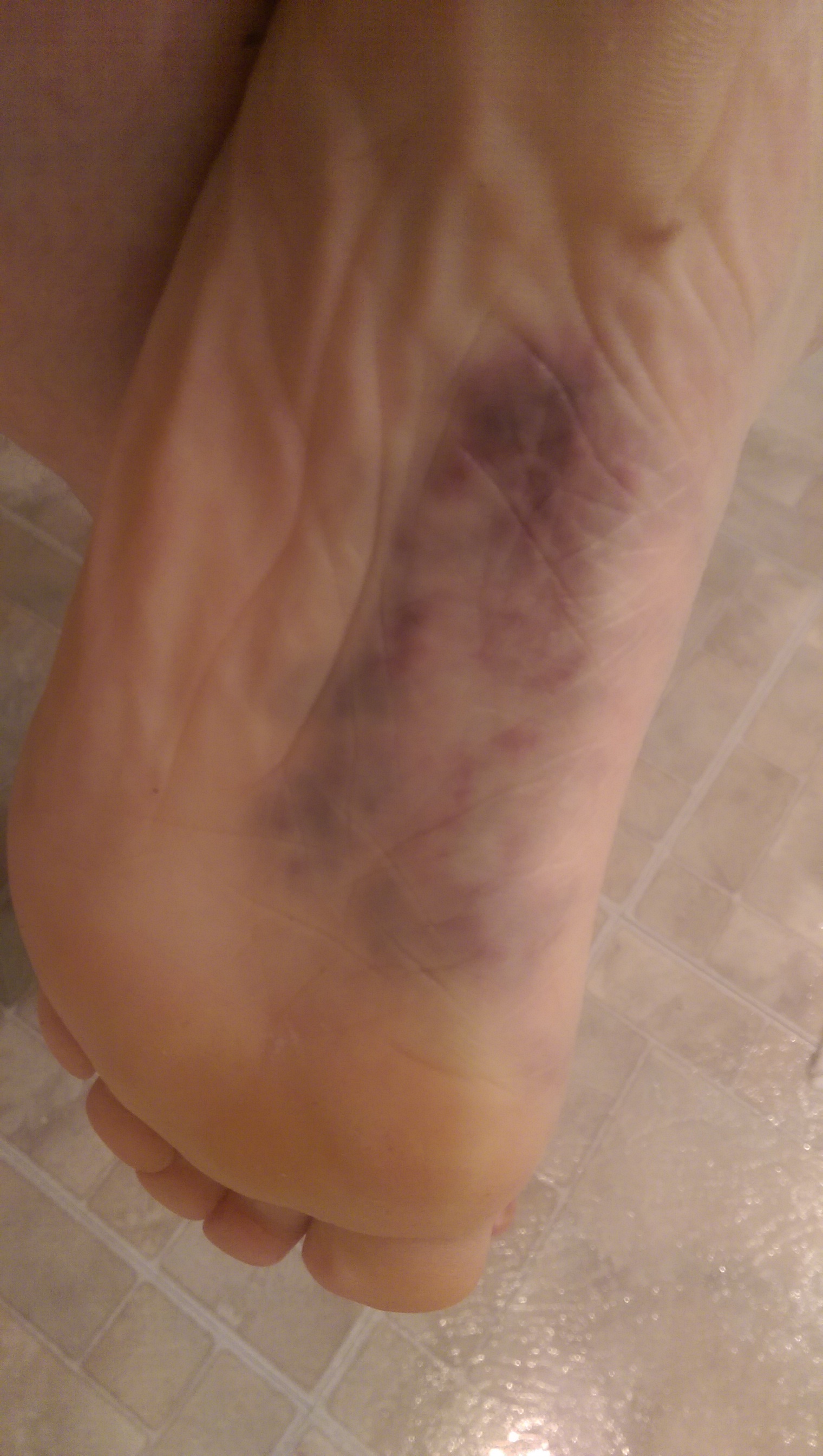 Plantar Fasciitis Massage Houston